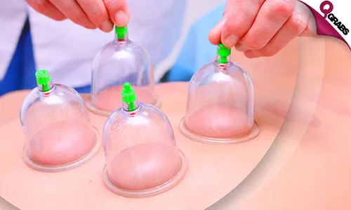 Full Body Wet Cupping/Hijama at Family Medical Polyclinic!